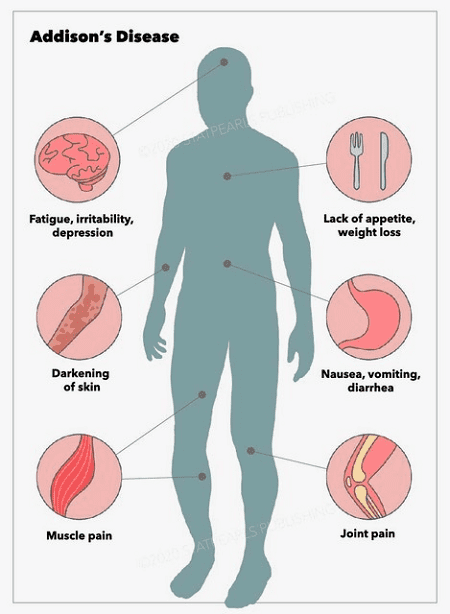 Class 11 Addison’s disease - Vrindawan Boarding School